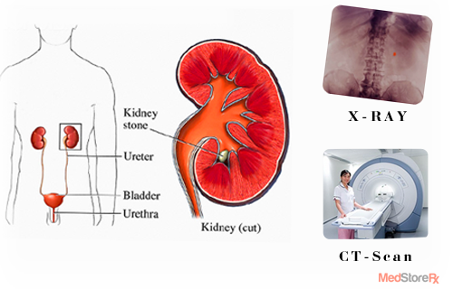 What is Kidney Stone and How to Diagnose It?