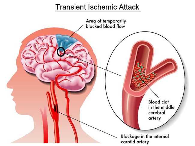 Transient Ischemic Attack