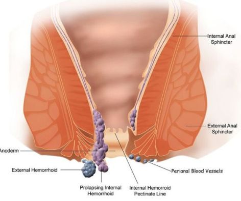 hemorrhoid