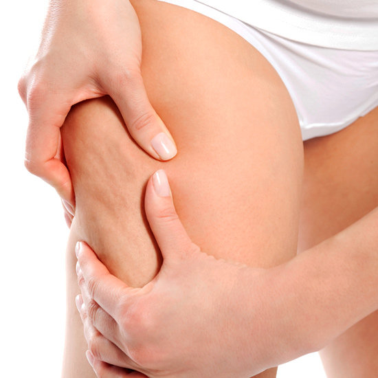 Cellulite