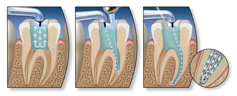 Endodontic-surgery