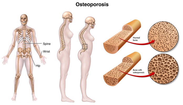 Osteoporosis_Causes