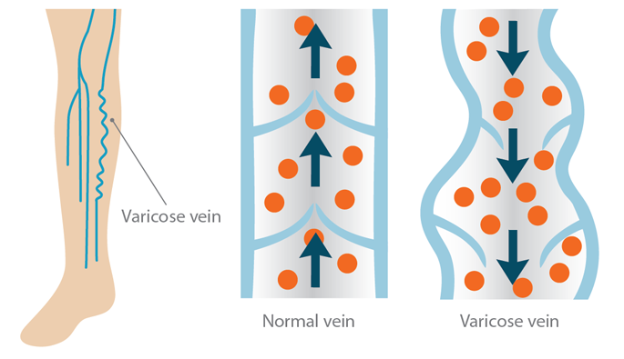 Varicose Veins