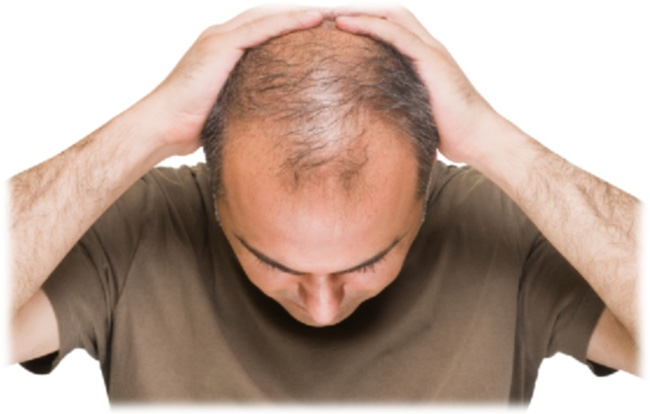 Propecia for Hair Loss