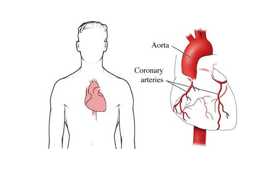 Coronary Artery Disease