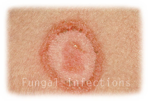 Fungal Infections