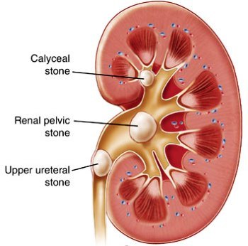 Kidney Stones in Men