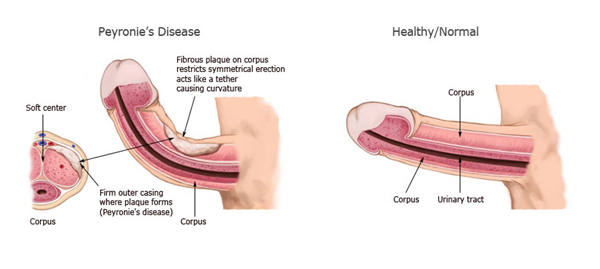 Peyronie Disease