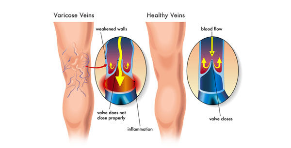 Varicose veins