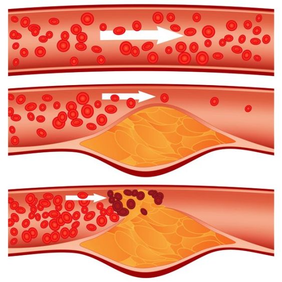 arteries contraction