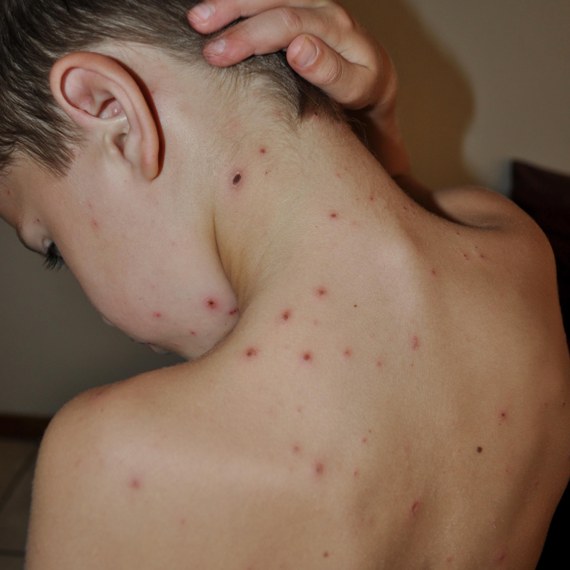 chicken pox