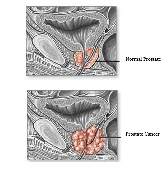 details info on Prostate cancer