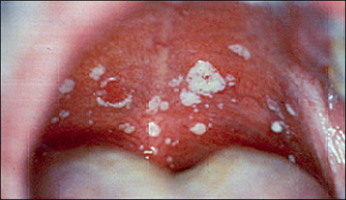 oral-thrush-candida