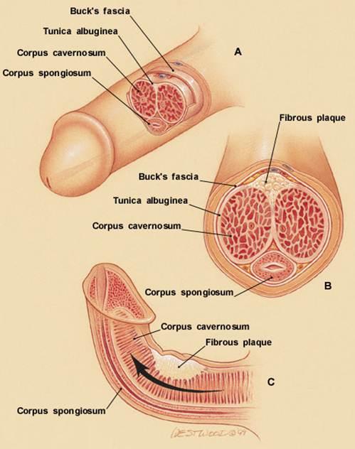 peyronies