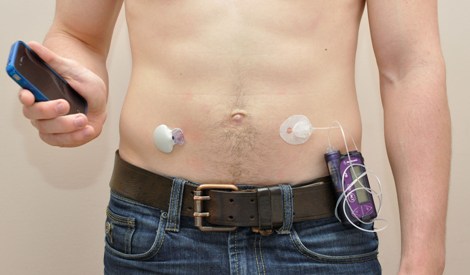 Artificial pancreas