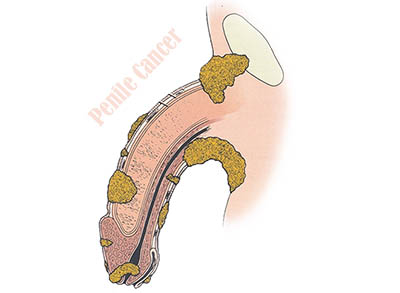 Penile cancer