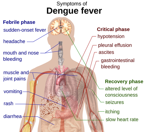 Dengue_fever_symptoms