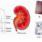 Kidney Stone