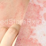 Blog-Bacterial-Skin-Infections-Over-Health